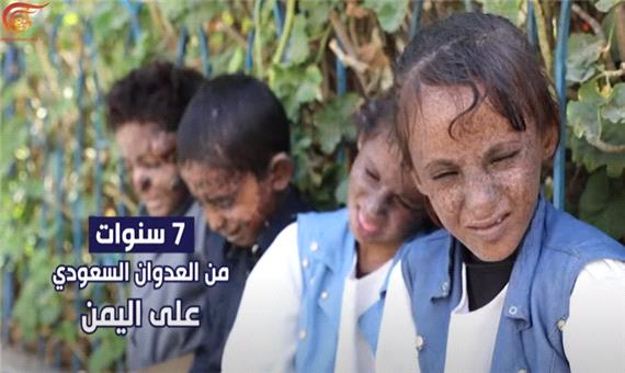 4 خردسال یمنی که بمباران سعودی کودکی و چهره شان را نابود کرد (+16)